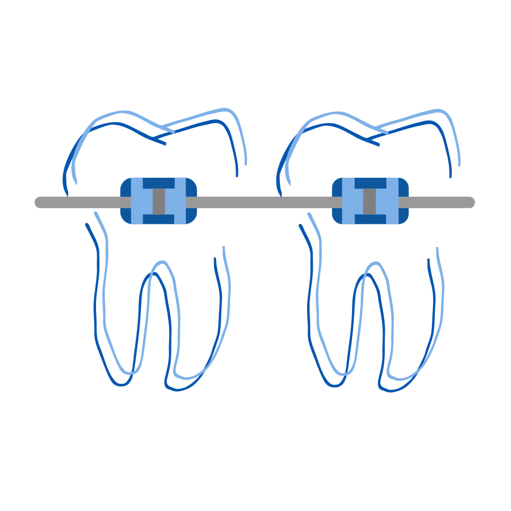 Aligner Kieferorthopädie